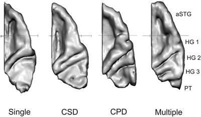Auditory Cortex Morphology Predicts Language Learning Potential in Children and Teenagers